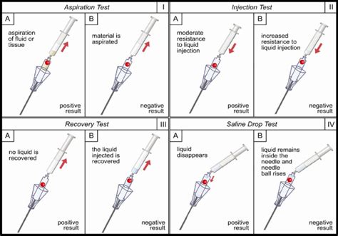 Needle positioning tests: Aspiration test: aspiration using a 5 ml 